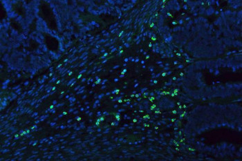 Myeloperoxidase (MPO) Antibody Endometrial Cancer IF. Immunofluorescent staining of FFPE human endometrial cancer tissue using MPO Antibody demonstrates distinct green fluorescence within scattered infiltrating myeloid cells distributed throughout the tumor-associated stromal compartment. The staining pattern is consistent with expression of Myeloperoxidase (MPO), a heme-containing peroxidase enzyme abundantly expressed in neutrophils, granulocytes, and other myeloid lineage cells involved in innate immune responses. MPO-positive cells are readily distinguished from the surrounding tumor tissue, highlighting inflammatory cell infiltration within the endometrial carcinoma microenvironment. Nuclei are counterstained with DAPI (blue). Heat-mediated antigen retrieval was performed in pH 8.0 EDTA buffer prior to overnight primary antibody incubation and fluorescent secondary antibody detection.