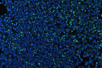 Myeloperoxidase (MPO) Antibody Stomach Cancer IF. Immunofluorescent staining of FFPE human stomach cancer tissue using MPO Antibody demonstrates distinct green fluorescence within scattered infiltrating inflammatory cells distributed throughout the tumor microenvironment. The staining pattern is consistent with expression of Myeloperoxidase (MPO), a heme-containing lysosomal peroxidase highly expressed in neutrophils, granulocytes, and other myeloid lineage cells involved in innate immune defense. MPO-positive cells are readily identifiable against a background of predominantly negative gastric carcinoma cells, highlighting tumor-associated myeloid infiltrates within the neoplastic tissue. The observed staining is consistent with the established use of MPO as a marker of granulocytic differentiation and inflammatory cell identification in cancer tissues. Nuclei are counterstained with DAPI (blue). Heat-mediated antigen retrieval was performed in pH 8.0 EDTA buffer prior to overnight primary antibody incubation and fluorescent secondary antibody detection.