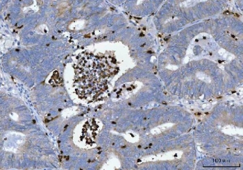 Myeloperoxidase (MPO) Antibody Endometrial Adenocarcinoma IHC. Immunohistochemistry staining of FFPE human endometrial adenocarcinoma tissue using MPO Antibody demonstrates strong granular cytoplasmic HRP-DAB brown staining in infiltrating myeloid cells located within glandular lumina and throughout the tumor-associated stromal compartment. The staining pattern is consistent with expression of Myeloperoxidase (MPO), a heme-containing peroxidase abundantly expressed in neutrophils, granulocytes, and other cells of myeloid lineage. MPO-positive inflammatory cells are readily distinguished from the surrounding neoplastic epithelial cells, highlighting the presence of tumor-associated myeloid infiltrates within the endometrial carcinoma microenvironment. The observed staining is consistent with the established use of MPO as a marker of granulocytic differentiation and myeloid cell identification in both normal and neoplastic tissues. HIER: boil tissue sections in pH 8 EDTA buffer for 20 minutes and allow to cool before testing.