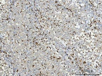 Myeloperoxidase (MPO) Antibody Lung Adenocarcinoma IHC. Immunohistochemistry staining of FFPE human lung adenocarcinoma tissue using MPO Antibody demonstrates scattered granular cytoplasmic HRP-DAB brown staining in infiltrating myeloid cells distributed throughout the tumor parenchyma and stromal compartments. The staining pattern is consistent with expression of Myeloperoxidase (MPO), a heme-containing lysosomal enzyme characteristically expressed in neutrophils, granulocytic precursors, and other cells of myeloid lineage. MPO-positive inflammatory cells are readily identified against a background of predominantly negative neoplastic epithelial cells, highlighting the presence of tumor-associated myeloid infiltrates within the lung adenocarcinoma microenvironment. The observed staining is consistent with the established use of MPO as a marker of granulocytic differentiation and innate immune cell infiltration in normal and malignant tissues. HIER: boil tissue sections in pH 8 EDTA buffer for 20 minutes and allow to cool before testing.