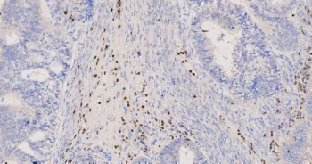 Myeloperoxidase (MPO) Antibody Endometrial Cancer IHC. Immunohistochemistry staining of FFPE human endometrial cancer tissue using MPO Antibody demonstrates scattered granular cytoplasmic HRP-DAB brown staining within infiltrating inflammatory cells located throughout the tumor-associated stromal compartment. The staining pattern is consistent with expression of Myeloperoxidase (MPO), a heme-containing peroxidase enzyme abundantly expressed in neutrophils, granulocytes, and other myeloid lineage cells involved in innate immune responses. MPO-positive inflammatory cells are readily distinguished from the surrounding neoplastic epithelial elements, highlighting the presence of tumor-associated myeloid infiltrates within the endometrial carcinoma microenvironment. The observed staining is consistent with the established use of MPO as a marker of granulocytic differentiation and myeloid cell identification in both normal and malignant tissues. HIER: heat-mediated antigen retrieval in pH 8.0 EDTA buffer prior to overnight primary antibody incubation and HRP-DAB chromogenic detection.