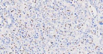 Myeloperoxidase (MPO) Antibody Stomach Cancer IHC. Immunohistochemistry staining of FFPE human stomach cancer tissue using MPO Antibody demonstrates scattered granular cytoplasmic HRP-DAB brown staining within infiltrating inflammatory cells distributed throughout the tumor microenvironment. The staining pattern is consistent with expression of Myeloperoxidase (MPO), a heme-containing peroxidase enzyme highly expressed in neutrophils, granulocytes, and other myeloid lineage cells. MPO-positive inflammatory cells are readily identifiable against a background of predominantly negative gastric carcinoma cells, highlighting the presence of tumor-associated myeloid infiltrates within the neoplastic tissue. The observed staining is consistent with the established use of MPO as a marker of granulocytic differentiation, innate immune activity, and myeloid cell identification in both normal and malignant tissues. HIER: heat-mediated antigen retrieval in pH 8.0 EDTA buffer prior to overnight primary antibody incubation and HRP-DAB chromogenic detection.