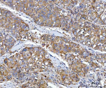 IHC staining of FFPE human liver cancer tissue with Src antibody. HIER: boil tissue sections in pH8 EDTA for 20 min and allow to cool before testing.