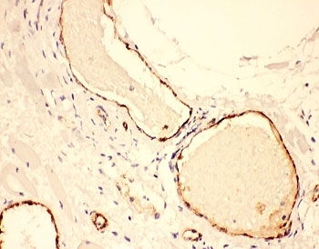 vWF Antibody / Microvessel Density Marker Antibody. Immunohistochemistry analysis of human lung cancer tissue shows HRP-DAB brown staining of endothelial cells forming discrete microvascular profiles within the tumor microenvironment. Numerous small-caliber vessels and capillary-like structures are clearly delineated, allowing visualization of microvessel distribution between tumor cell clusters. The staining pattern supports identification and assessment of microvessel density by highlighting individual endothelial-lined structures across the tissue section. HIER: steam section in pH6 citrate buffer for 20 min and allow to cool prior to testing.