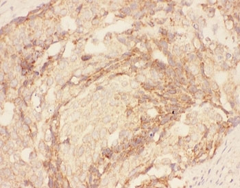 Eotaxin-3 Antibody Human Breast Cancer IHC. IHC staining of FFPE human breast cancer tissue with Eotaxin-3 antibody demonstrated cytoplasmic and membranous staining in malignant epithelial cells and surrounding stromal components, consistent with the expression pattern of Eotaxin-3 (CCL26), a CC chemokine that regulates eosinophil recruitment and Th2-associated immune responses. Eotaxin-3 participates in inflammatory signaling through CCR3 and contributes to communication between tumor cells and the immune microenvironment. The staining observed in both neoplastic and stromal compartments is consistent with reported expression of CCL26 in epithelial tumors and inflammatory tissues. These results support the utility of Eotaxin-3 Antibody for studies of chemokine biology, allergic inflammation, eosinophil trafficking, and tumor-associated immune responses.