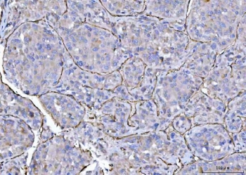 IHC staining of FFPE human hepatocellular carcinoma tissue with CD31 antibody. HIER: boil tissue sections in pH8 EDTA for 20 min and allow to cool before testing.