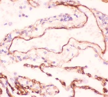 Immunohistochemistry of Collagen IV antibody in human lung cancer tissue. Formalin-fixed, paraffin-embedded human lung carcinoma tissue was stained using a rabbit polyclonal Collagen IV antibody. Heat induced epitope retrieval was performed by boiling tissue sections in 10mM citrate buffer, pH 6, for 10-20 min followed by cooling prior to staining. Linear brown chromogenic staining highlights basement membrane structures surrounding tumor nests and vascular channels, consistent with Collagen type IV alpha 1 chain localization in the extracellular matrix.