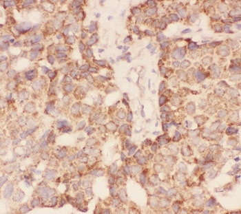 IFSH beta Antibody Breast Cancer Immunohistochemistry. HC-P: FSH beta antibody testing of human breast cancer tissue.