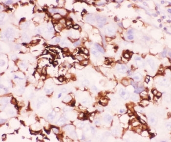 IHC staining of FFPE human intestinal cancer tissue with LFA-1 antibody. HIER: boil tissue sections in pH8 EDTA for 20 min and allow to cool before testing.