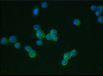 IHC staining of FFPE human lung cancer tissue with LFA-1 antibody. HIER: boil tissue sections in pH8 EDTA for 20 min and allow to cool before testing.