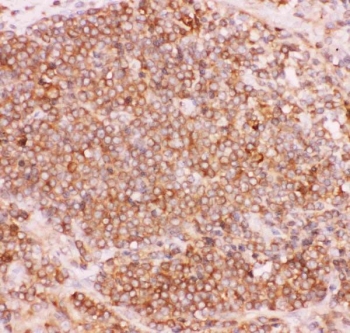 NFKB2 Antibody Lung Cancer IHC. Immunohistochemistry staining of FFPE human lung cancer tissue with NFKB2 antibody. HIER: boil tissue sections in pH8 EDTA for 20 min and allow to cool before testing.