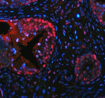 p63 Antibody for IF. Immunofluorescence analysis of FFPE human prostate hyperplasia tissue using a rabbit polyclonal p63 antibody for IF demonstrates strong nuclear staining in basal epithelial cells (red), consistent with the role of Tumor protein 63 (TP63) as a nuclear transcription factor. Signal is restricted to the basal cell layer surrounding glandular structures, while luminal epithelial cells remain largely negative, clearly outlining epithelial architecture and basal cell compartments. DAPI nuclear counterstain (blue) labels all nuclei, providing contrast for precise identification of TP63-positive cells within the tissue. Heat-induced epitope retrieval was performed by steaming sections in pH 8 EDTA buffer for 20 minutes prior to antibody incubation.