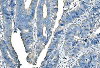 IHC staining of FFPE human adenocarcinoma of the rectum with BRAF antibody. HIER: boil tissue sections in pH8 EDTA for 20 min and allow to cool before testing.