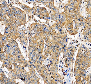 G6PD Antibody Human Liver Cancer IHC. Immunohistochemical staining of FFPE human liver cancer tissue using G6PD Antibody at 2 ug/ml with HRP/DAB detection following heat-induced epitope retrieval in pH8 EDTA buffer. Moderate to strong cytoplasmic staining is observed throughout the tumor cells, consistent with the expected localization of the G6PD enzyme in the cytosol. This staining pattern demonstrates the utility of G6PD Antibody, a Pentose Phosphate Pathway Enzyme Antibody, for investigating G6PD expression, cellular metabolism and oxidative stress in human liver cancer.
