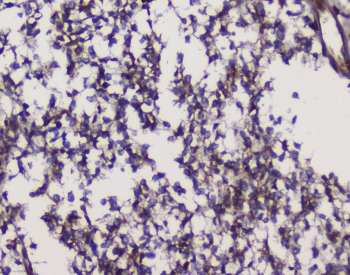 IHC staining of FFPE human glioma with GRIK1 antibody at 1ug/ml. HIER: boil tissue sections in pH6, 10mM citrate buffer, for 10-20 min and allow to cool before testing.