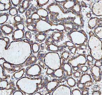IHC staining of FFPE human thyroid cancer tissue with Heme Oxygenase 2 antibody. HIER: boil tissue sections in pH8 EDTA buffer for 20 min and allow to cool before testing.