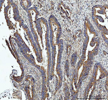 IHC staining of FFPE human colorectal adenocarcinoma tissue with Heme Oxygenase 2 antibody. HIER: boil tissue sections in pH8 EDTA buffer for 20 min and allow to cool before testing.