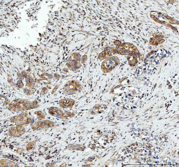 IHC staining of FFPE human appendix mucinous adenocarcinoma tissue with Heme Oxygenase 2 antibody. HIER: boil tissue sections in pH8 EDTA buffer for 20 min and allow to cool before testing.