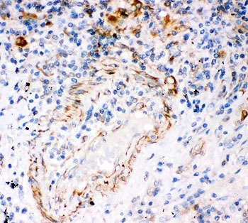 IHC-P: IP3R antibody testing of human lung cancer tissue. HIER: steam section in pH6 citrate buffer for 20 min.