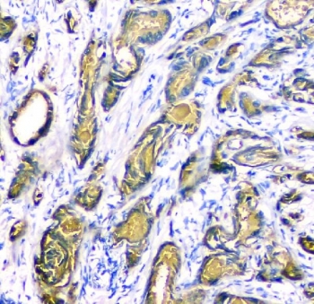 Prostate Specific Antigen Rabbit Polyclonal IHC staining of human prostate cancer. Immunohistochemistry analysis of FFPE human prostate carcinoma using Prostate Specific Antigen Rabbit Polyclonal demonstrates HRP-DAB brown cytoplasmic staining in malignant glandular epithelial cells forming irregular tumor glands, consistent with Prostate specific antigen (KLK3) expression in prostate-derived tumor epithelium. Surrounding stromal cells are largely negative. HIER: tissue sections were boiled in pH 8 EDTA buffer for 20 minutes and allowed to cool before testing.