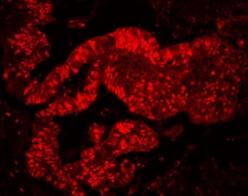 MCM7 Antibody for IF - immunofluorescence of human colon cancer tissue. FFPE human colon cancer tissue was stained with MCM7 Antibody for IF using a rabbit polyclonal antibody targeting Minichromosome maintenance complex component 7 / MCM7. Strong nuclear fluorescence is observed in many carcinoma epithelial cells, consistent with the nuclear localization of this DNA replication licensing factor and the high proliferative activity characteristic of colon cancer. Antigen retrieval was performed by steaming tissue sections in pH6 citrate buffer for 20 minutes prior to staining.