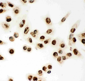 MCM7 Antibody ICC. Immunocytochemical staining of FFPE human A549 cells with MCM7 antibody. HIER: steam section in pH6 citrate buffer for 20 min.