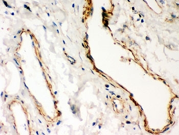 Dystrophin Antibody Lung Cancer Immunohistochemistry. IHC-P: Dystrophin antibody testing of human lung cancer tissue.
