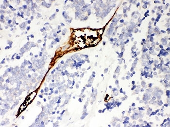 IHC of Mesothelin antibody in human lung cancer tissue. The rabbit polyclonal antibody demonstrates focal HRP-DAB brown staining localized to tumor-associated epithelial cells, with predominantly membranous and cytoplasmic signal consistent with Mesothelin expression in carcinoma cells. Surrounding stromal and inflammatory cells show minimal background staining. Heat-induced epitope retrieval was performed by steaming sections in pH 6 citrate buffer prior to antibody incubation.