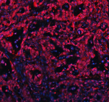 Immunofluorescent staining of FFPE human pancreas cancer tissue with c-Myb antibody (red) and DAPI nuclear stain (blue). HIER: steam section in pH8 EDTA buffer for 20 min.