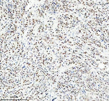 IHC staining of FFPE human breast cancer tissue with NEDD9 antibody. HIER: boil tissue sections in pH8 EDTA for 20 min and allow to cool before testing.