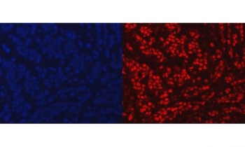 PARP1 Antibody Breast Cancer IF. Immunofluorescence analysis of FFPE human breast cancer tissue using PARP1 antibody. PARP1 staining (red) demonstrates widespread nuclear localization within tumor cell populations, consistent with the chromatin-associated activity of this repair protein in DNA strand break signaling and genomic stability maintenance pathways. Nuclei are counterstained blue with DAPI. Heat-induced epitope retrieval was performed by steaming tissue sections in pH8 EDTA buffer for 20 minutes prior to staining.