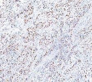 PARP1 Antibody Bladder Tissue IHC. Immunohistochemistry analysis of FFPE human bladder tissue using PARP1 antibody. Urothelial and stromal cell nuclei demonstrate HRP-DAB brown staining consistent with the chromatin-associated localization of PARP1 in DNA repair, genomic surveillance, and nuclear stress-response signaling pathways. Nuclei are counterstained blue. Heat-induced epitope retrieval was performed by boiling tissue sections in pH8 EDTA buffer for 20 minutes followed by cooling prior to staining.