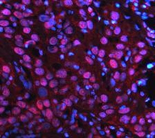 PARP1 Antibody Bladder Cancer IF. Immunofluorescence analysis of FFPE human bladder cancer tissue using PARP1 antibody. PARP1 staining (red) demonstrates strong nuclear localization within tumor cell populations, consistent with the chromatin-associated role of this repair protein in genomic stability maintenance and nuclear stress-response signaling pathways in proliferative carcinoma tissue. Nuclei are counterstained blue with DAPI. Heat-induced epitope retrieval was performed by steaming tissue sections in pH8 EDTA buffer for 20 minutes prior to staining.