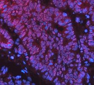 PARP1 Antibody Stomach Cancer IF. Immunofluorescence analysis of FFPE human stomach cancer tissue using PARP1 antibody. PARP1 staining (red) demonstrates predominantly nuclear localization within gastric tumor epithelial cells, consistent with the chromatin-associated activity of this repair protein in genomic surveillance and cellular stress-response signaling pathways. Nuclei are counterstained blue with DAPI. Heat-induced epitope retrieval was performed by steaming tissue sections in pH8 EDTA buffer for 20 minutes prior to staining.