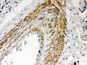 PKC Iota Antibody / PRKCI Antibody Human Lung Cancer IHC. Immunohistochemical staining of FFPE human lung cancer tissue using PKC Iota Antibody / PRKCI Antibody. PRKCI expression is observed predominantly within the cytoplasm of tumor cells, consistent with its established role as an atypical serine/threonine kinase involved in cell polarity, intracellular signaling, proliferation, and tumor progression. Heat-induced epitope retrieval was performed prior to immunostaining.
