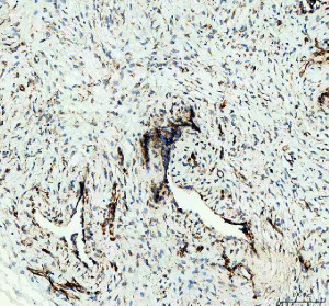 HSP47 Antibody Breast Cancer IHC. HSP47 Antibody was used for immunohistochemical staining of FFPE human breast cancer tissue following heat-induced epitope retrieval in pH 8 EDTA buffer. The section was incubated with the primary antibody at 2 ug/ml, followed by an HRP-conjugated goat anti-rabbit secondary antibody and DAB chromogen for visualization. Distinct cytoplasmic staining is observed within tumor-associated stromal cells and collagen-producing regions, consistent with the endoplasmic reticulum localization and collagen chaperone function of SERPINH1. This HSP47 Antibody, a Collagen Chaperone Antibody, is well suited for investigating extracellular matrix remodeling, collagen biosynthesis, fibrosis, and the stromal response associated with breast cancer.