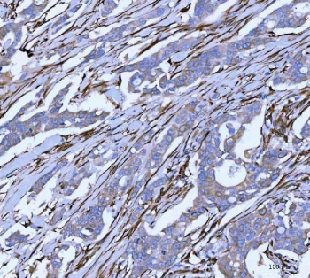 HSP47 Antibody Human Breast Cancer Tissue IHC. HSP47 Antibody was used for immunohistochemical staining of FFPE human breast cancer tissue following heat-induced epitope retrieval in pH 8 EDTA buffer. The tissue was incubated with the primary antibody, followed by an HRP-conjugated secondary antibody and DAB chromogen for visualization. Strong cytoplasmic staining is observed in malignant epithelial cells with additional labeling of stromal spindle-shaped cells, consistent with the endoplasmic reticulum localization and collagen chaperone function of SERPINH1. This HSP47 Antibody, a Collagen Chaperone Antibody, is well suited for investigating collagen biosynthesis, extracellular matrix remodeling, fibrosis, and the tumor microenvironment in breast cancer.