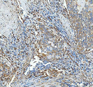 HSP47 Antibody Human Esophageal Squamous Carcinoma IHC. HSP47 Antibody was used for immunohistochemical staining of FFPE human esophageal squamous carcinoma tissue following heat-induced epitope retrieval in pH 8 EDTA buffer. The section was incubated with the primary antibody at 2 ug/ml, followed by an HRP-conjugated goat anti-rabbit secondary antibody and DAB chromogen for detection. Moderate to strong cytoplasmic staining is observed within malignant squamous epithelial cells and the surrounding stromal compartment, consistent with the expression pattern of the collagen-specific chaperone SERPINH1 during extracellular matrix remodeling. This HSP47 Antibody, a Collagen Chaperone Antibody, is useful for studying collagen biosynthesis, tumor-associated fibrosis, and stromal remodeling in esophageal cancer.