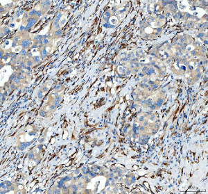 HSP47 Antibody Human Appendiceal Adenocarcinoma IHC. HSP47 Antibody was used for immunohistochemical staining of FFPE human appendiceal adenocarcinoma tissue following heat-induced epitope retrieval in pH 8 EDTA buffer. The section was incubated with the primary antibody at 2 ug/ml, followed by an HRP-conjugated goat anti-rabbit secondary antibody and DAB chromogen for detection. Prominent cytoplasmic staining is observed within stromal spindle-shaped cells and surrounding connective tissue, with weaker staining present in subsets of tumor cells, consistent with the role of SERPINH1 in collagen biosynthesis and extracellular matrix remodeling. This HSP47 Antibody, a Collagen Chaperone Antibody, is valuable for investigating fibrosis, collagen deposition, and stromal remodeling within the tumor microenvironment.