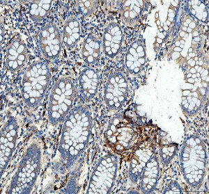 HSP47 Antibody Human Colon Cancer IHC. HSP47 Antibody was used for immunohistochemical staining of FFPE human colon cancer tissue following heat-induced epitope retrieval in pH 8 EDTA buffer. The section was incubated with the primary antibody at 2 ug/ml, followed by an HRP-conjugated goat anti-rabbit secondary antibody and DAB chromogen for detection. Predominant cytoplasmic staining is observed within stromal fibroblast-like cells surrounding the colonic glands, with comparatively weaker staining in the epithelial tumor cells, reflecting the collagen-associated expression pattern of SERPINH1 during extracellular matrix remodeling. This HSP47 Antibody, a Collagen Chaperone Antibody, is well suited for investigating collagen biosynthesis, tumor-associated fibrosis, and stromal remodeling in colorectal cancer.