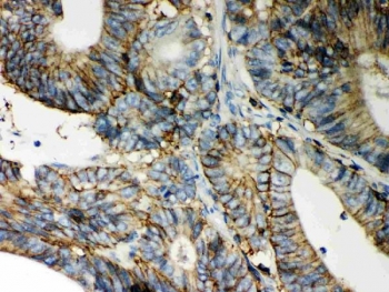 CD44 Antibody Intestinal Cancer IHC. Immunohistochemistry staining of FFPE human intestinal cancer with CD44 antibody. HIER: boil tissue sections in pH6, 10mM citrate buffer, for 10-20 min and allow to cool before testing.