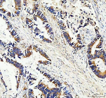 IHC staining of FFPE human colon cancer tissue with SERPINB5 antibody. HIER: boil tissue sections in pH8 EDTA for 20 min and allow to cool before testing.