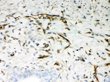 Vimentin Antibody / Tumor Microenvironment Marker Antibody Human Breast Cancer IHC. Immunohistochemical staining of FFPE human breast cancer tissue using Vimentin Antibody / Tumor Microenvironment Marker Antibody. Vimentin expression is observed predominantly within stromal fibroblasts and other mesenchymal cells of the tumor microenvironment, consistent with its role in cytoskeletal remodeling, cell migration, and stromal support of tumor progression. Heat-induced epitope retrieval was performed by boiling tissue sections in pH 8 EDTA for 20 minutes followed by cooling prior to immunostaining.