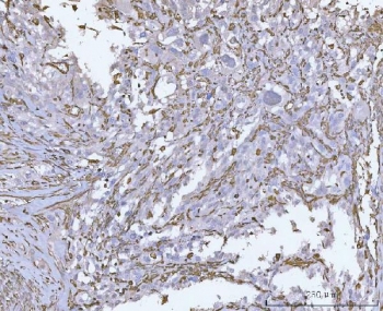 Vimentin Antibody / Tumor Microenvironment Marker Antibody Human Invasive Urothelial Carcinoma IHC. Immunohistochemical staining of FFPE human invasive urothelial carcinoma tissue using Vimentin Antibody / Tumor Microenvironment Marker Antibody. Vimentin expression is observed predominantly within stromal fibroblasts, infiltrating mesenchymal cells, and vascular elements of the tumor microenvironment, consistent with its role in extracellular matrix remodeling, epithelial-to-mesenchymal transition, and the invasive behavior of urothelial carcinoma. Heat-induced epitope retrieval was performed by boiling tissue sections in pH 8 EDTA for 20 minutes followed by cooling prior to immunostaining.