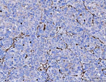 Vimentin Antibody / Tumor Microenvironment Marker Antibody Human Liver Cancer IHC. Immunohistochemical staining of FFPE human liver cancer tissue using Vimentin Antibody / Tumor Microenvironment Marker Antibody. Vimentin expression is observed predominantly within stromal fibroblasts, vascular endothelial cells, and other mesenchymal components of the tumor microenvironment, consistent with its role in extracellular matrix remodeling, angiogenesis, and support of tumor progression. Heat-induced epitope retrieval was performed by boiling tissue sections in pH 8 EDTA for 20 minutes followed by cooling prior to immunostaining.