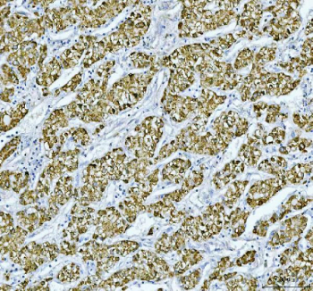 IHC staining of FFPE human liver cancer tissue with RBP4 antibody, HRP-labeled secondary and DAB substrate. HIER: boil tissue sections in pH8 EDTA for 20 min and allow to cool before testing.