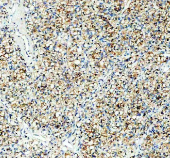 IHC staining of FFPE human renal cancer tissue with PGRMC1 antibody, HRP-secondary and DAB substrate. HIER: boil tissue sections in pH8 EDTA for 20 min and allow to cool before testing.
