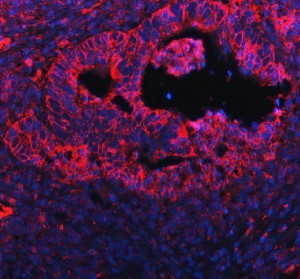 PGRMC1 Antibody Human Intestine Cancer IF. Immunofluorescent staining of FFPE human intestine cancer tissue with PGRMC1 Antibody at 5 ug/ml. HIER was performed using pH 8 EDTA buffer, followed by blocking with 10% goat serum. The tissue section was incubated with rabbit anti-PGRMC1 antibody overnight at 4Â°C, followed by Cy conjugated goat anti-rabbit IgG secondary antibody (red). Nuclei were counterstained with DAPI (blue). PGRMC1 Antibody / Progesterone Receptor Membrane Component Antibody demonstrates cytoplasmic staining and supports research into steroid signaling pathways, cancer biology and cell survival regulation.