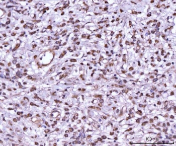 IHC testing of FFPE human testis cancer tissue with MKK7 antibody. HIER: Boil the paraffin sections in pH8 EDTA for 20 minutes and allow to cool prior to staining.