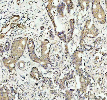 Immunohistochemistry analysis of SAPK4 in human breast cancer tissue. SAPK4 antibody was used to detect SAPK4 in paraffin-embedded human breast cancer tissue. Antigen retrieval was performed using EDTA buffer (pH 8.0). Tumor epithelial cells show cytoplasmic staining, while surrounding stromal cells display weaker signal. Detection was performed using an HRP-DAB system.